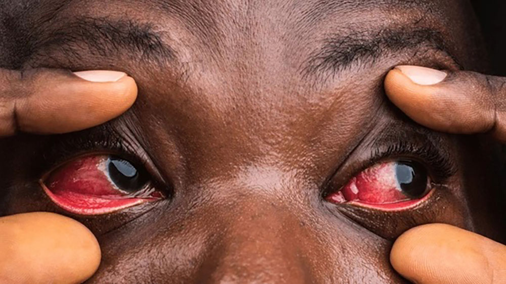 Red eye disease confirmed in Bushenyi